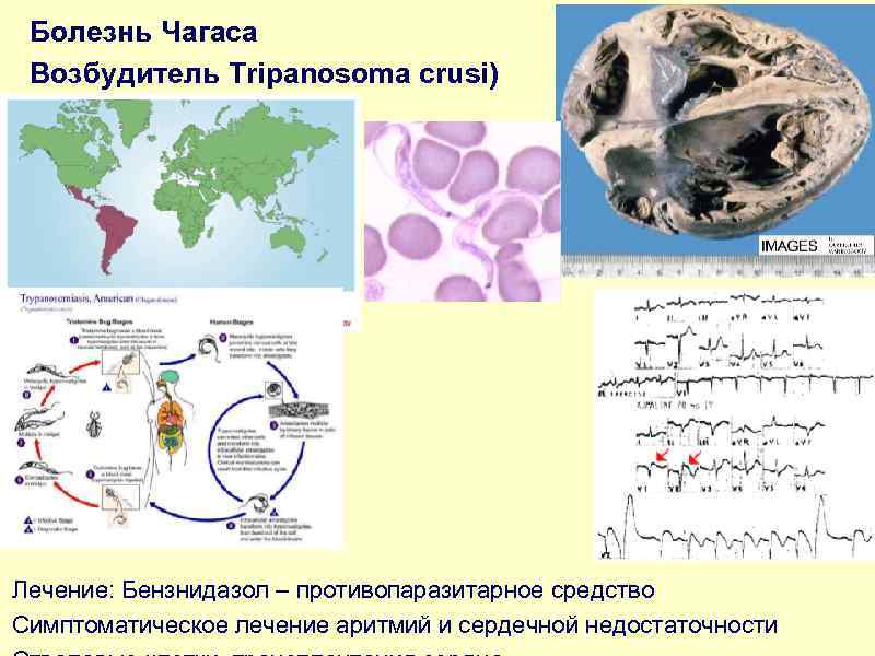 Болезнь Чагаса Возбудитель Tripanosoma crusi) Лечение: Бензнидазол – противопаразитарное средство Симптоматическое лечение аритмий и