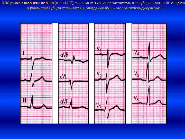 ЭОС резко отклонена вправо (α ≅ +120°), т. к. самые высокие положительные зубцы видны