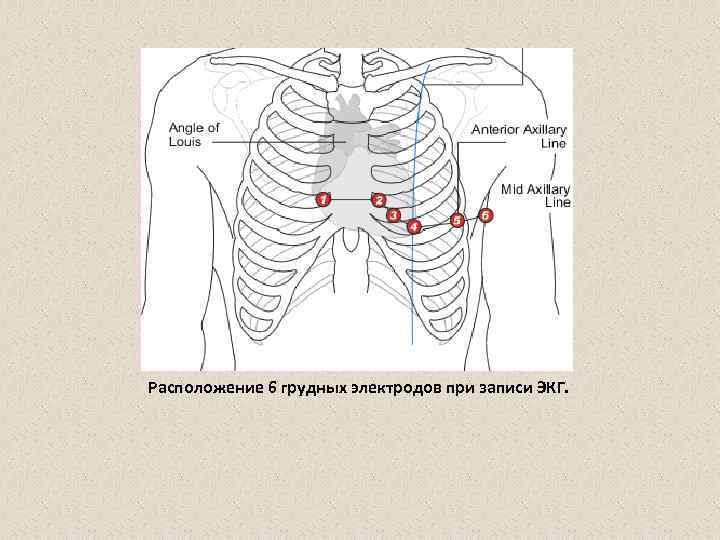 Расположение 6 грудных электродов при записи ЭКГ. 