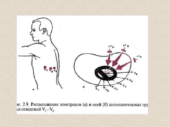 Левый дополнительный. Электроды v7 v8 v9. Дополнительные электроды на ЭКГ v7 v8 v9. Дополнительные грудные отведения v7-v9. ЭКГ отведения v7-v9.