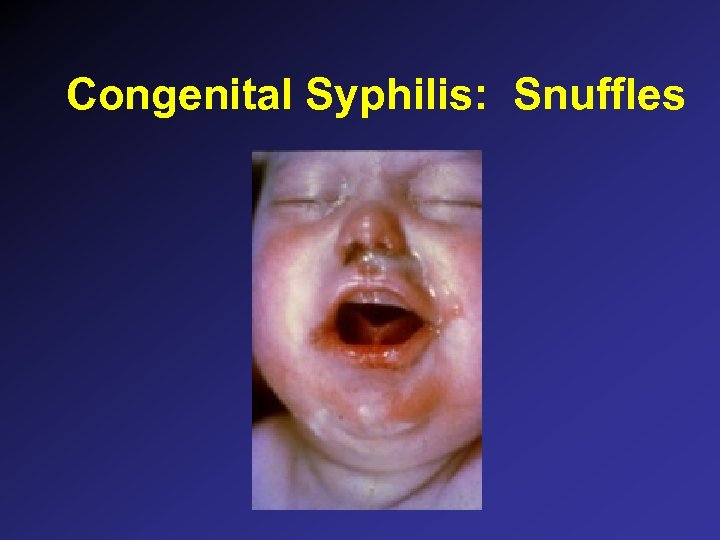 Congenital Syphilis: Snuffles 