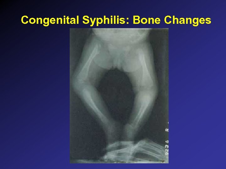 Congenital Syphilis: Bone Changes 