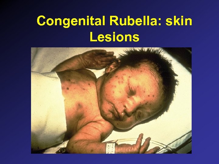 Congenital Rubella: skin Lesions 