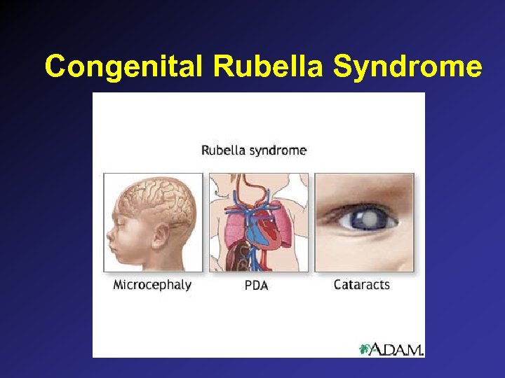 Congenital Rubella Syndrome 