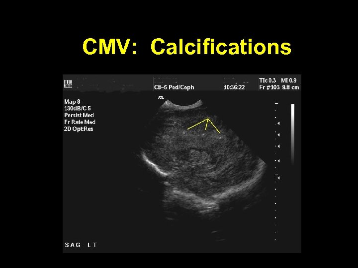 CMV: Calcifications 