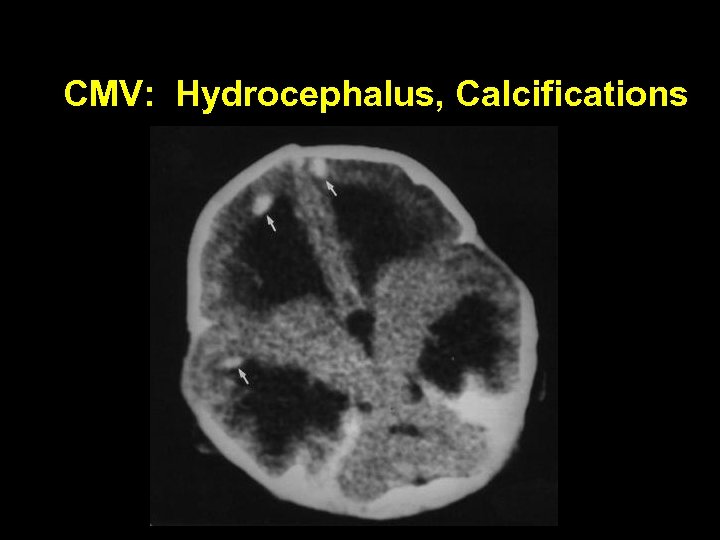 CMV: Hydrocephalus, Calcifications 