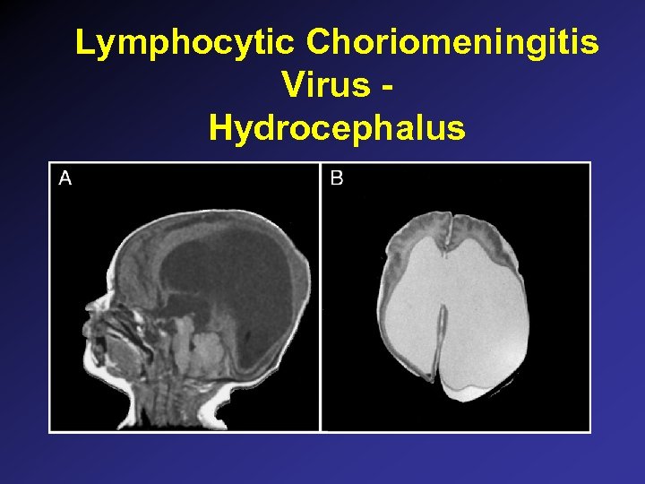 Lymphocytic Choriomeningitis Virus Hydrocephalus 