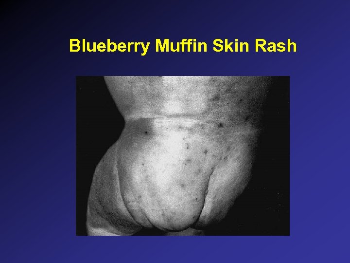 Blueberry Muffin Skin Rash 