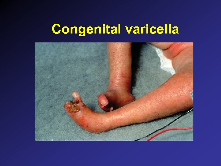 Congenital varicella 