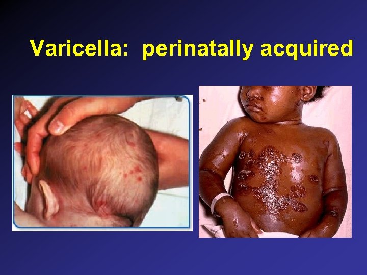 Varicella: perinatally acquired 