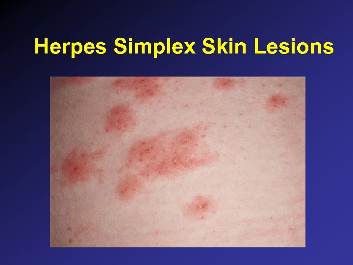 Herpes Simplex Skin Lesions 