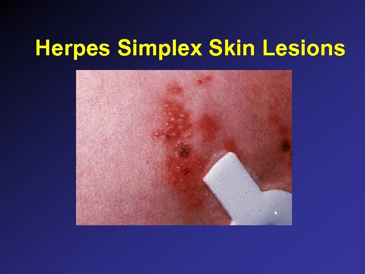 Herpes Simplex Skin Lesions 