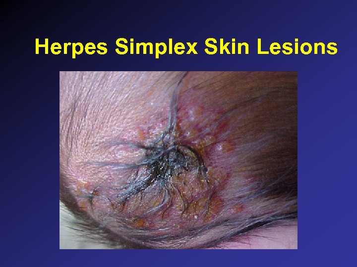 Herpes Simplex Skin Lesions 