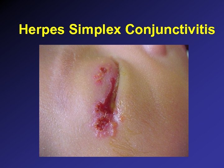 Herpes Simplex Conjunctivitis 