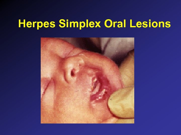 Herpes Simplex Oral Lesions 