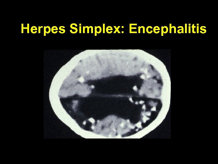 Herpes Simplex: Encephalitis 