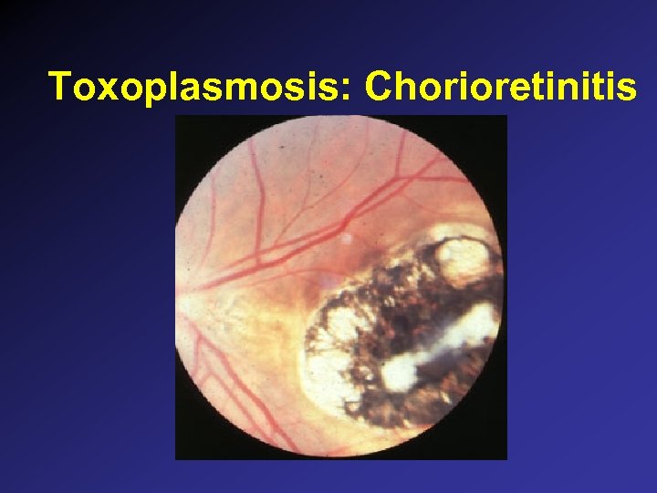 Toxoplasmosis: Chorioretinitis 