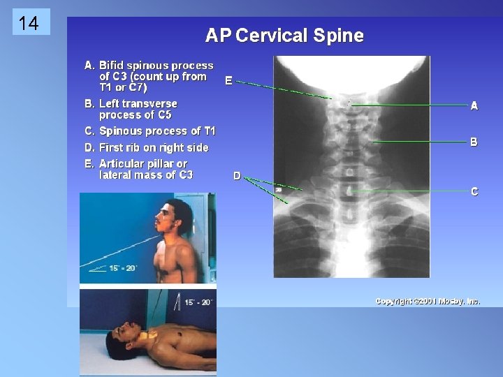 ap cervical spine x ray positioning