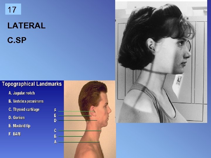 17 LATERAL C. SP 