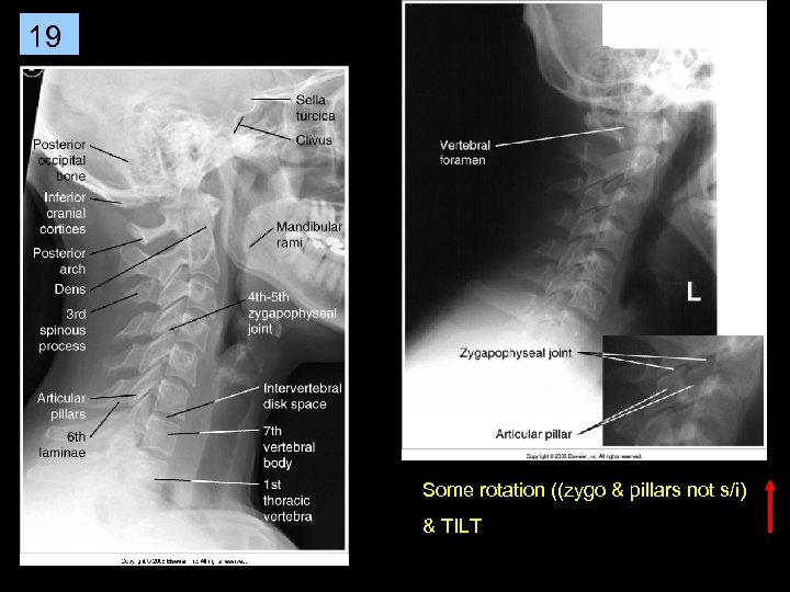 19 Some rotation ((zygo & pillars not s/i) & TILT 