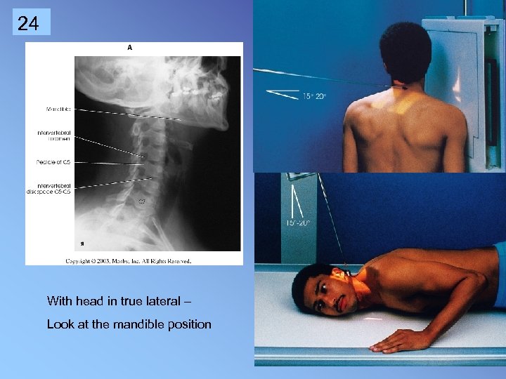 cervical spine oblique x ray positioning