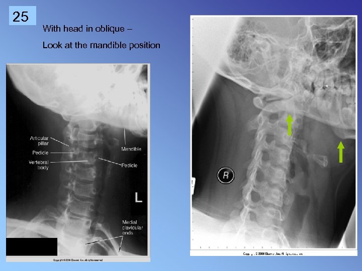 25 With head in oblique – Look at the mandible position 