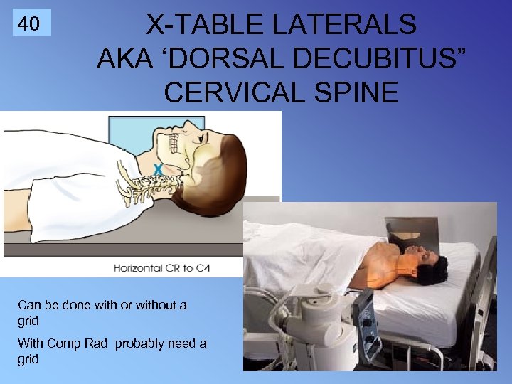 40 X-TABLE LATERALS AKA ‘DORSAL DECUBITUS” CERVICAL SPINE Can be done with or without