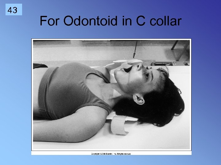 43 For Odontoid in C collar 