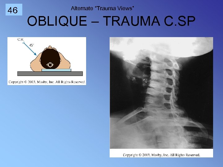 46 Alternate “Trauma Views” OBLIQUE – TRAUMA C. SP 