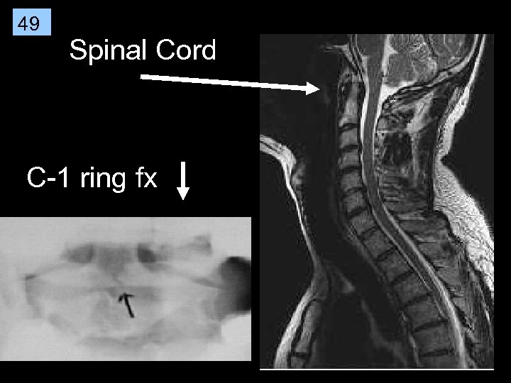 49 Spinal Cord C-1 ring fx 