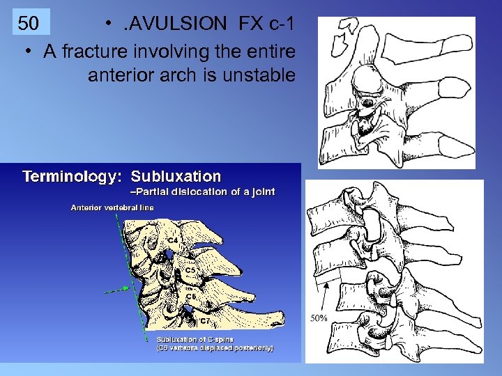 50 • . AVULSION FX c-1 • A fracture involving the entire anterior arch