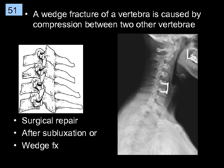 51 • A wedge fracture of a vertebra is caused by compression between two