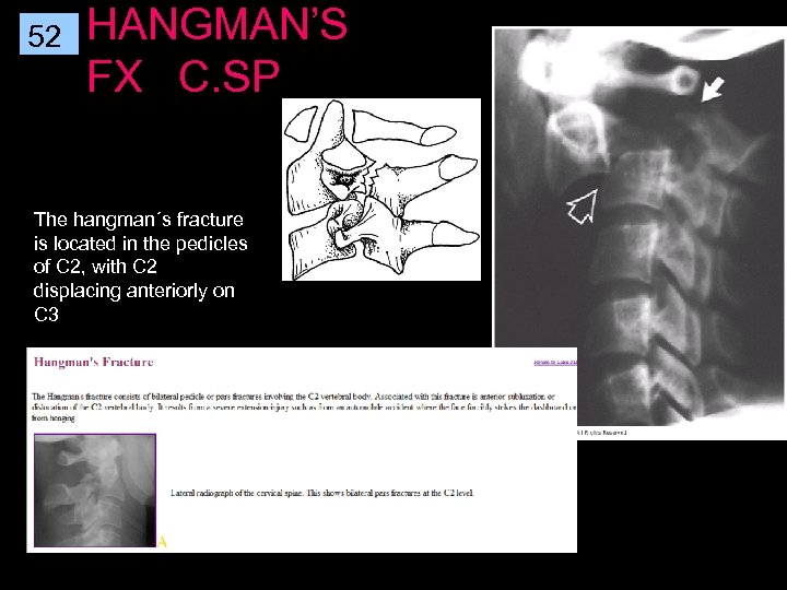 52 HANGMAN’S FX C. SP The hangman´s fracture is located in the pedicles of