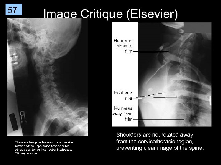 57 Image Critique (Elsevier) There are two possible reasons: excessive rotation of the upper