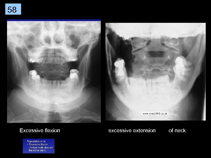 58 Excessive flexion excessive extension of neck 