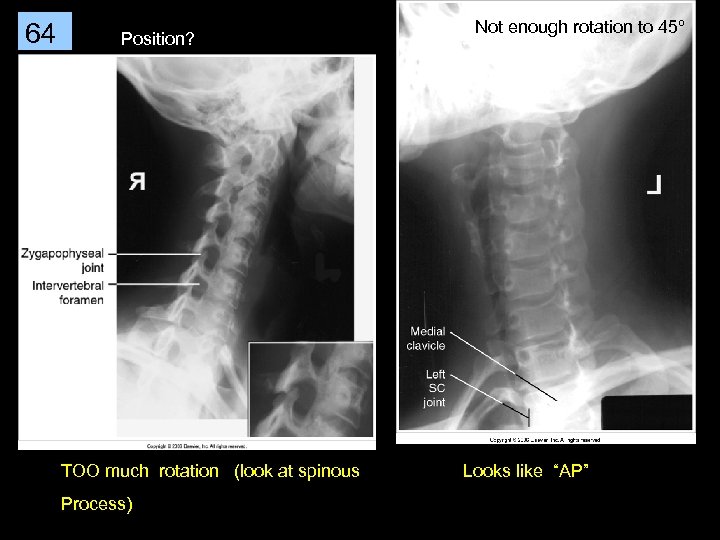 64 Position? TOO much rotation (look at spinous Process) Not enough rotation to 45º