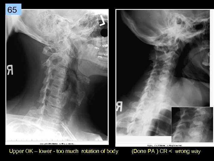 65 Upper OK – lower - too much rotation of body (Done PA )