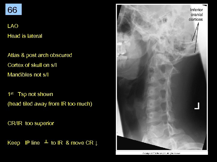 66 LAO Head is lateral Atlas & post arch obscured Cortex of skull on
