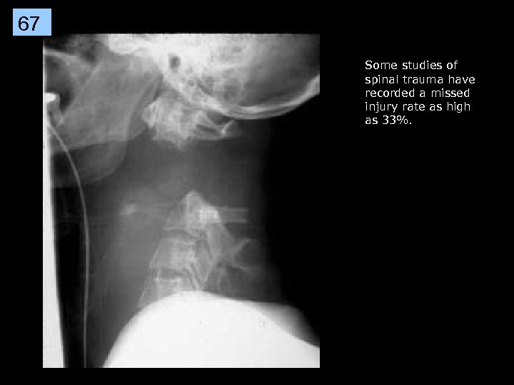 67 Some studies of spinal trauma have recorded a missed injury rate as high