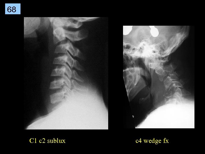 68 C 1 c 2 sublux c 4 wedge fx 