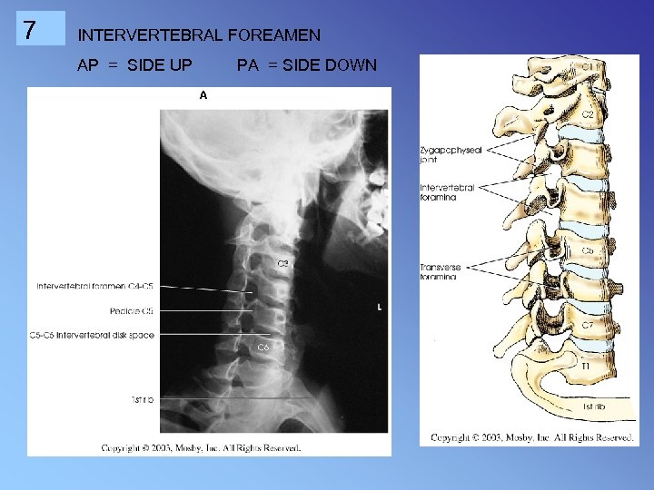 7 INTERVERTEBRAL FOREAMEN AP = SIDE UP PA = SIDE DOWN 