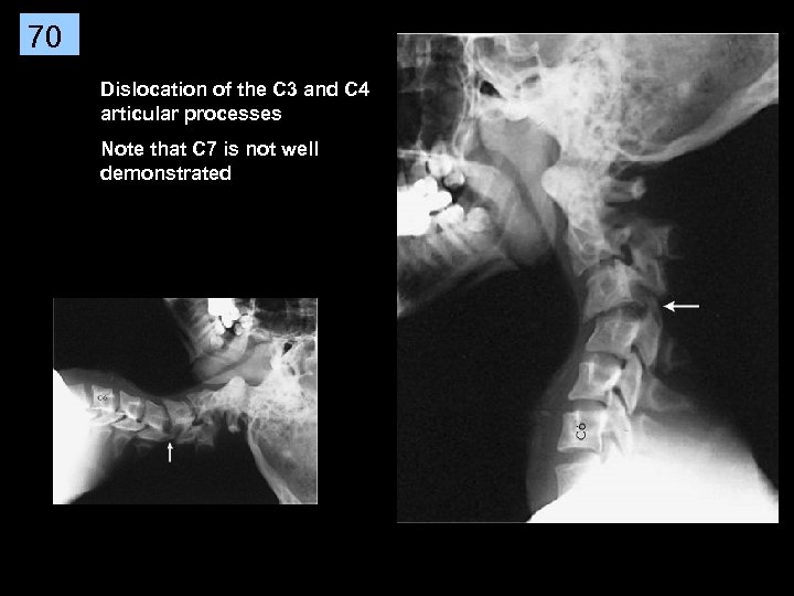 70 Dislocation of the C 3 and C 4 articular processes Note that C