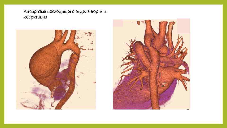 Презентация аневризма аорты