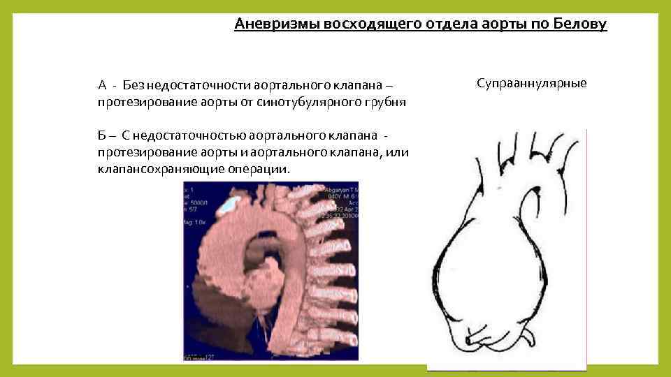 Аневризмы восходящего отдела аорты по Белову А - Без недостаточности аортального клапана – протезирование