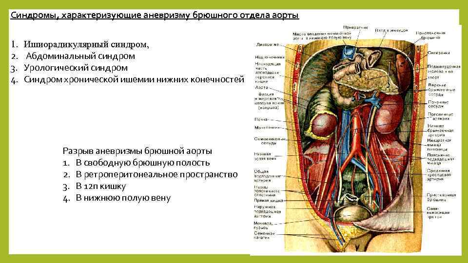 Аорта брюшной полости. Ишиорадикулярный синдром. Абдоминальный синдром аорта. Ишиорадикулярный синдром при аневризме брюшной аорты. Синдромы при аневризме брюшной аорте.