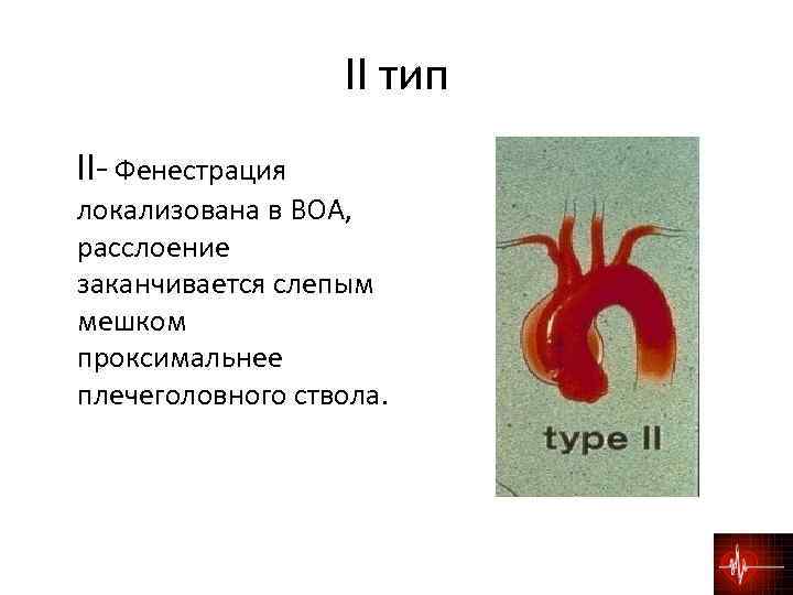 II тип II- Фенестрация локализована в ВОА, расслоение заканчивается слепым мешком проксимальнее плечеголовного ствола.