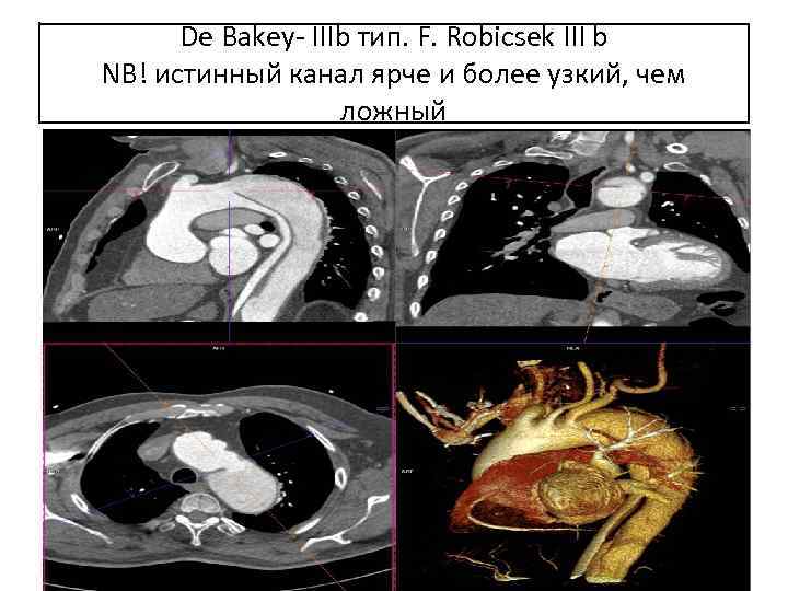 De Bakey- IIIb тип. F. Robicsek III b NB! истинный канал ярче и более