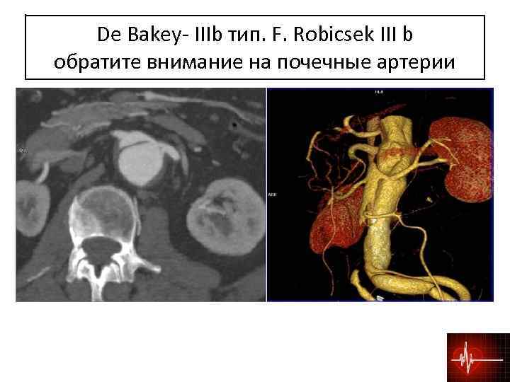 De Bakey- IIIb тип. F. Robicsek III b обратите внимание на почечные артерии 