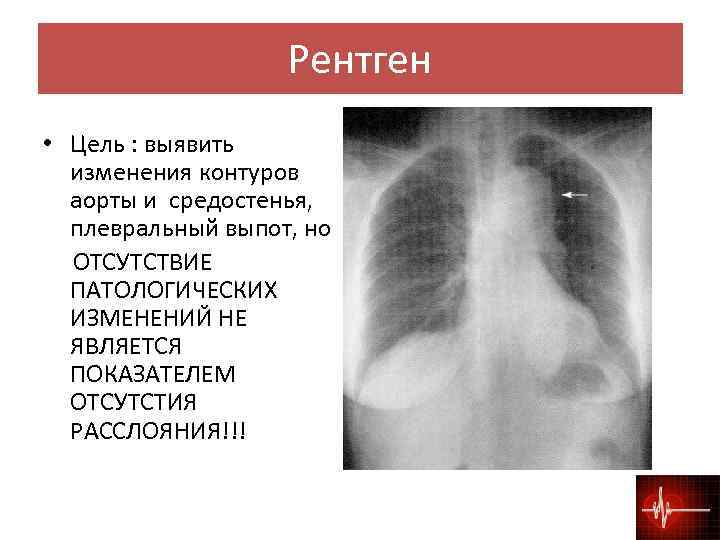 При расслоении аорты на фоне гипертензивного криза показаны прежде всего тест