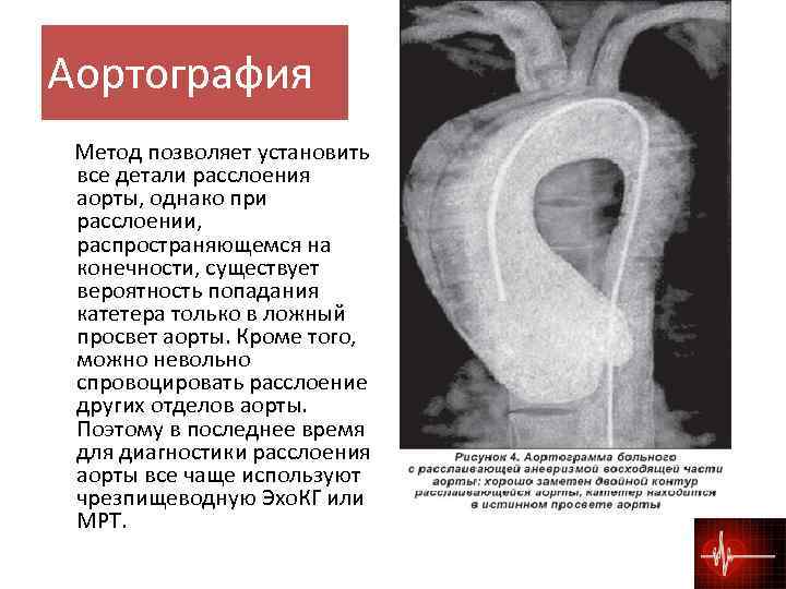 Расслоилась аорта. Расслоение аорты аортография. Аортография аневризма аорты. Аортография при аневризме аорты.